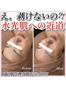 ホワイトアクア 天王寺本店(WHITE AQUA)/ララピールで肌荒れ改善/天王寺
