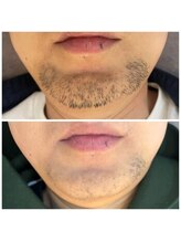 メンズビノス 福井店(VINOS)/ヒゲ脱毛