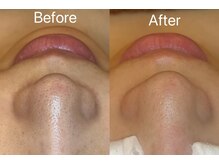 マドモアゼル 麻布十番の雰囲気（毛穴黒ずみ・角栓除去/毛穴洗浄）