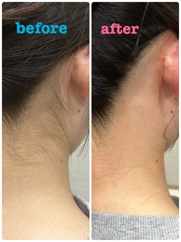 ギャラクシービューティー(galaxy beauty)/うなじ脱毛