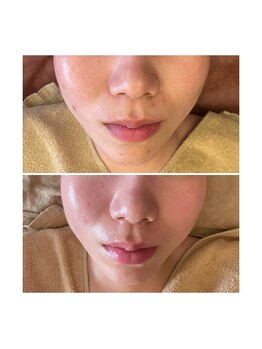 アクアンフィニィ(aquanfini)/得意のニキビケア・肌荒れ跡ケア