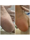 フットケア★ビフォーアフター★