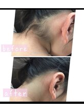 ケースタイル(k.style)/キッズ脱毛あり！