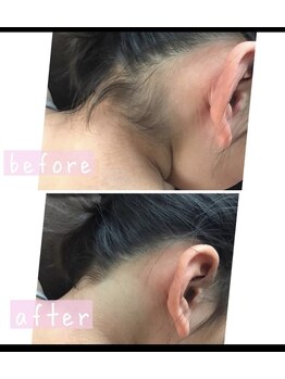 ケースタイル(k.style)/キッズ脱毛あり！