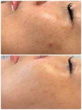 プリュネル(Prunelle)/プラズマシャワー