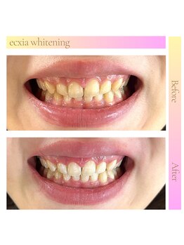 エクシアホワイトフジ(ecxia white fuji)/ホワイトニングビフォーアフター
