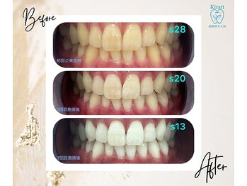 キラット 高知中万々店(Kiratt)/【クリスタルホワイトニング】