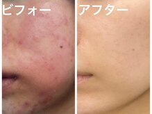 ナオフクオカ ヒーリングフォースエヌ(NaoFukuoka/healingforceN)/ヒト幹細胞で圧倒的な変化と美肌