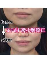 アコルデ 岡山問屋町(ACORDE)/小顔矯正ver.6