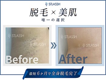 ストラッシュ 福岡天神店(STLASSH)/メニュー：全身脱毛（ワキ/脇）