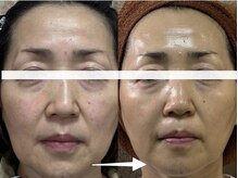 ジューンブライド(June Bride 61)/５５歳　劇的ビフォーアフター