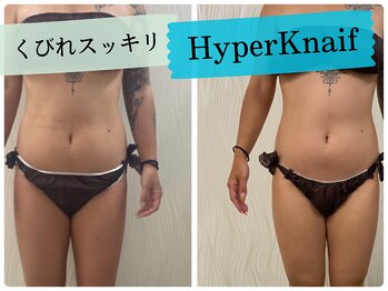 ソルニス(Solnis.)/痩身☆脂肪分解/ハイパーナイフ