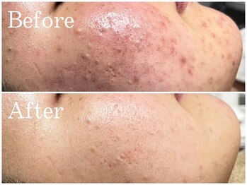 リブ(Lib)/天然素材本格ハーブピーリング