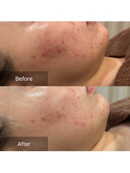 ハピエスト 田辺店/水光肌ピーリング