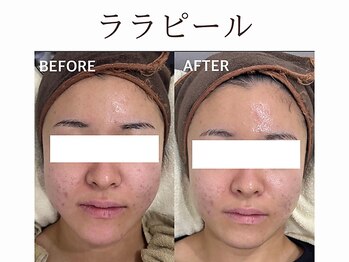 ティアム バイ テトテ 神戸三宮(TIAM by tetote)/ララピール1回施術