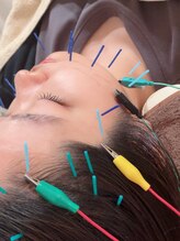 瑞 鍼灸院/頭皮鍼+美容鍼