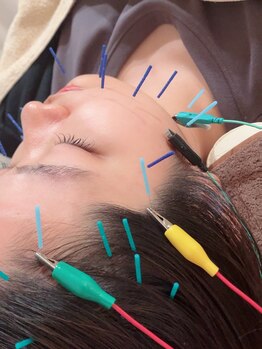 瑞 鍼灸院/頭皮鍼+美容鍼