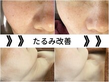 ブーガルーバリ(Boogaloo BALI)の雰囲気（【たるみ改善】老化にブレーキを！たるみ改善なら美顔筋！）