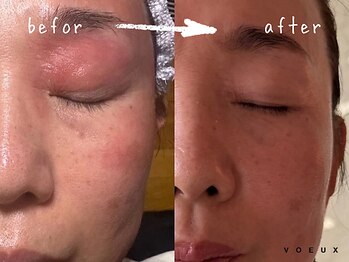 ボウ 名古屋店(VOEUX)/５０代　敏感ケア　２５回