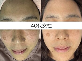 サクラ 伊勢原店(SAKURA)/シミケアと言ったらSAKURA