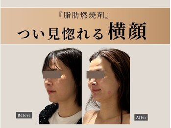 ナチュリ センター南院(NACHUL)/横顔も怖くない!口元もすっきり