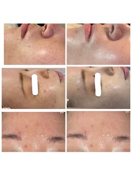 ピュアリ(Purely) /最先端美容!メソスキンカラー