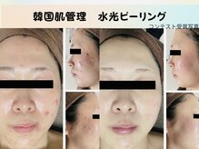 レイズ(RAISE)の雰囲気(当店人気No.1 韓国肌管理 水光ピーリングエイジングケアにも◎)