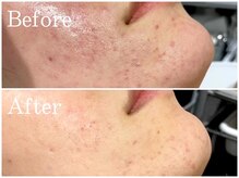 リブ(Lib)/天然素材本格ハーブピーリング