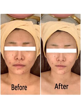 スペチアーレ 夙川/無制限ハイリフ×オキシジェネオ