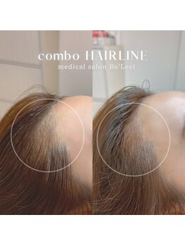 ベリール(Be'Leel)/combo &nbsp;Hair line