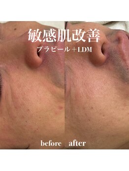 イロハ(IROHA)/敏感肌改善!