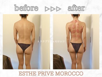 エステプリヴェモロッコ(ESTHE PRIVE MOROCCO)/人気No.1カッサカッピング