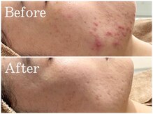 リブ(Lib)/天然素材本格ハーブピーリング