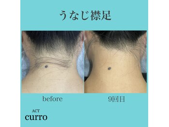 アクト クロ(ACT curro)/【うなじ襟足】脱毛施術例