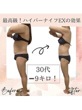 サロン ド ボーテ ラーンジュ 岐阜店(salon de beaut'e L'ange)/ハイパ-ナイフEX2ダイエット痩身
