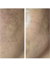 アマラ(Amarra)/顔のノイズ改善は光フェイシャル