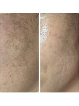 アマラ(Amarra)/顔のノイズ改善は光フェイシャル