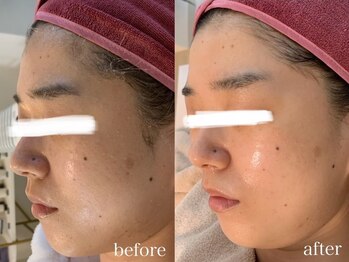 ユルリ(YURURI)/ビフォーアフター（角質ケア）