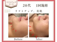 リュミエール(Lumiere)/【症例】リフトアップコース　