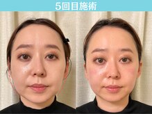 ナチュラルパーフェクトフェイス 新宿/5回目施術