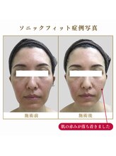 リリーオン 札幌店(RILLEE-ON)/肌質改善、赤ら顔改善！