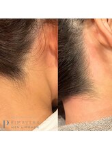 プリマベーラ 箕面店(Primavera)/うなじ脱毛