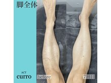 アクト クロ(ACT curro)/【脚全体】脱毛施術例