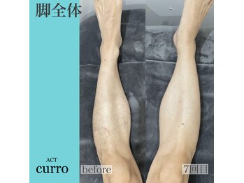 アクト クロ(ACT curro)/【脚全体】脱毛施術例