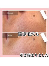 エクラーレ(Eclale)/ハーブピーリング症例