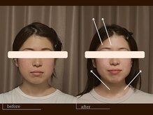 クレスト(CREST)/ビフォーアフター【小顔名古屋】