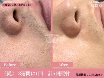 フェレザ 新潟(Felleza)/男性ビフォー&アフター写真