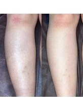 ニカ(NIKA)/ひざ下脱毛