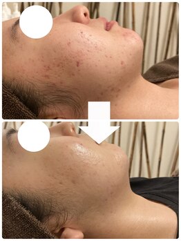 ヴィヴフォー(VIV for)/ニキビケアに