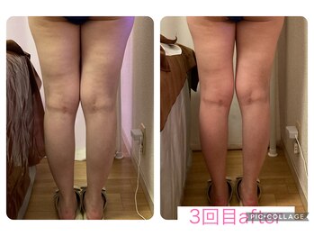 ベルフルールエム(Belle Fleur.M)/痩身70分3回目の効果